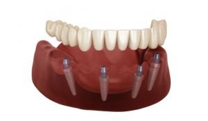 All On 4 / All On X Permanent Zirconia Teeth