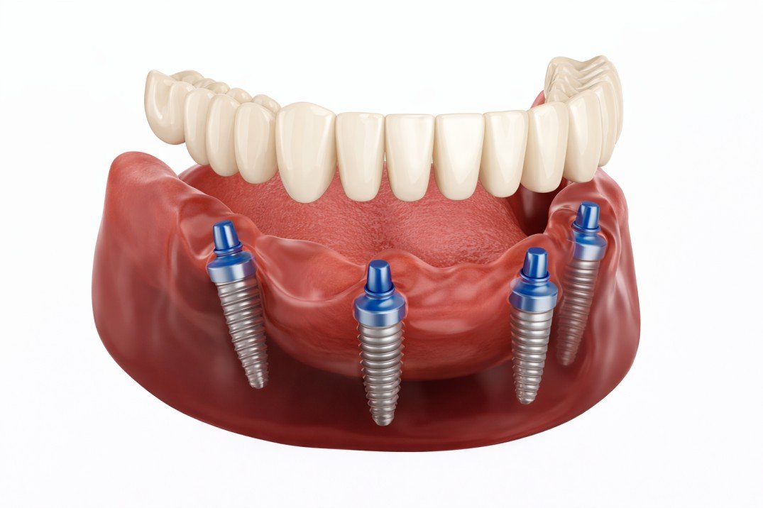 All On 4 Dental Implants Vacaville