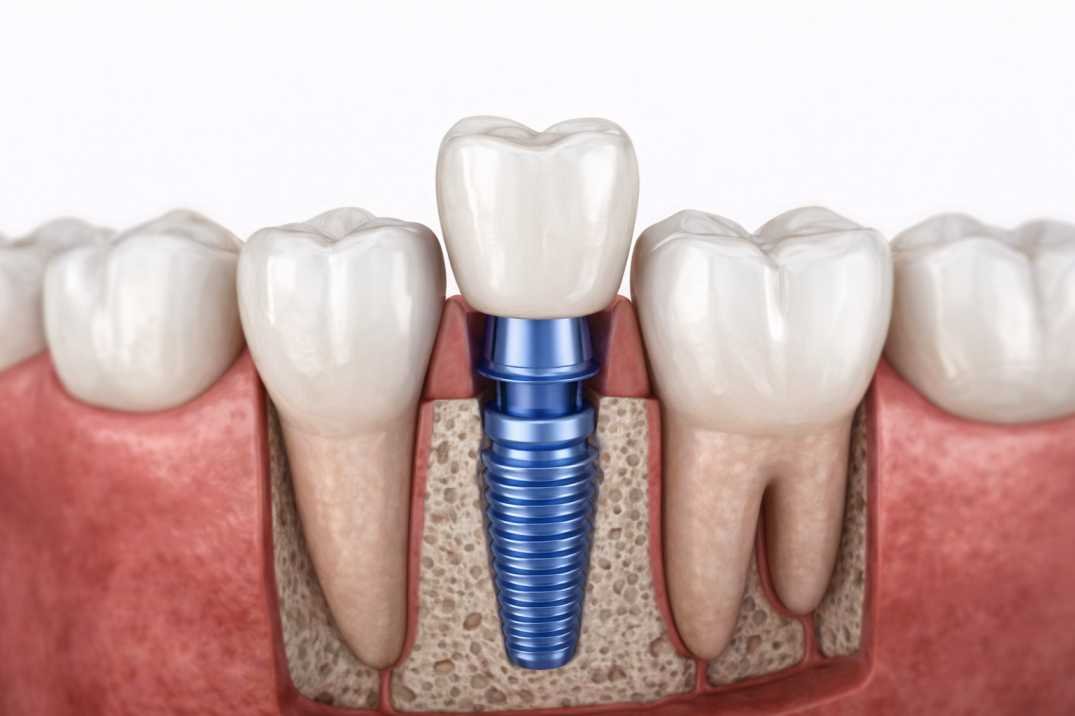 Single Tooth Dental Implant
