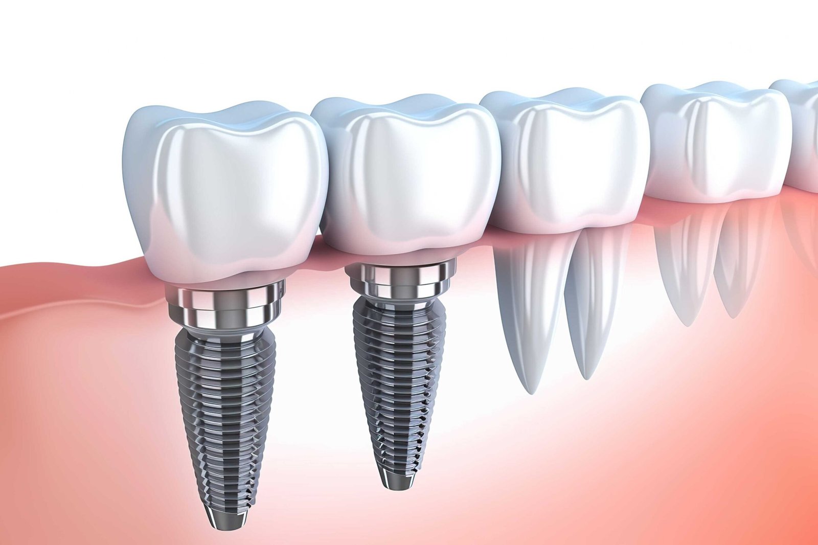 Affordable Dental Implants